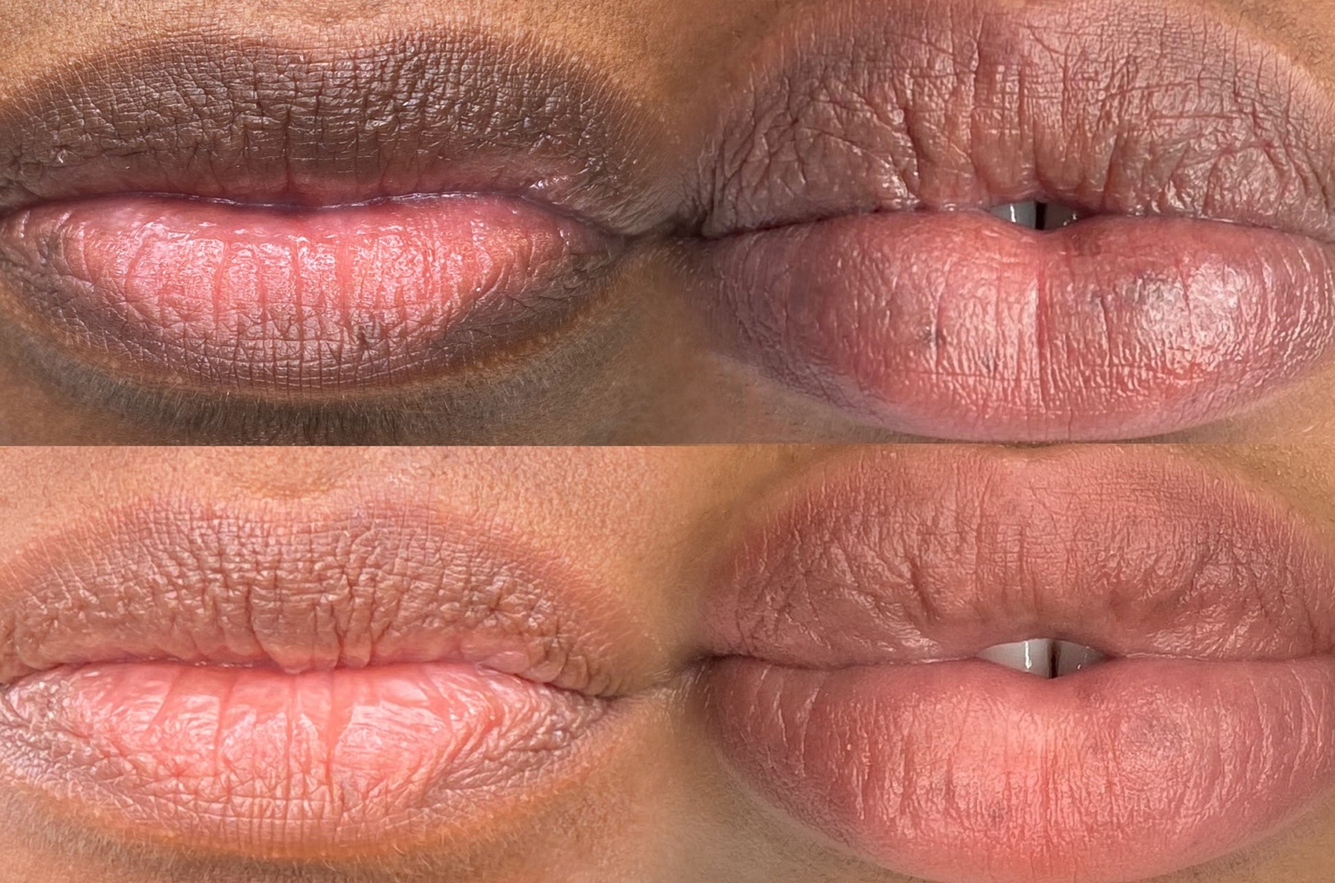 French Kissy Baume - Ne cherche plus ! Nous avons enfin trouvé la solution pour éclaircir tes lèvres afin d'obtenir une teinte uniformes et naturelles.  En effet, peu importe les raisons pour lesquelles tes lèvres sont foncées ( consommation de tabac, utilisation de produits décapants, ou même raisons génétiques), avec le baume French Kissy, tes lèvres retrouveront une couleur harmonieuse et unifiée.